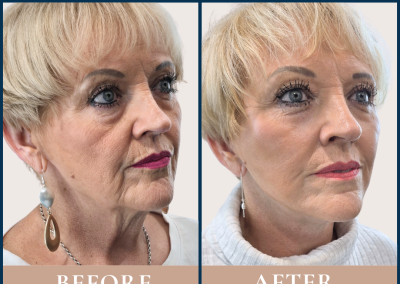 best deep plane facelift in Sydney - Dr Vlad ILLIE - plastic surgeon in Sydney known for natural-looking facelifts