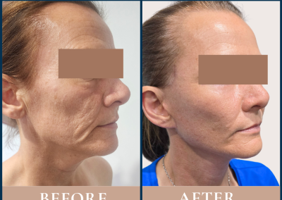 best deep plane facelift before and after - Sydney - Dr Vlad ILLIE