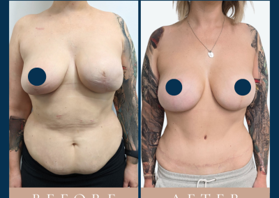 best breast reconstruction with DIEP free flap in Sydney - Dr Vlad ILLIE, specialist plastic and reconstructive surgeon, St Vincent's Hospital Sydney