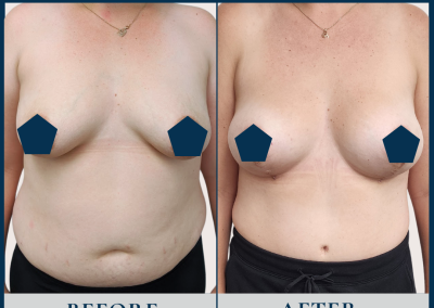 best breast reconstruction with DIEP free flap in Sydney - Dr Vlad ILLIE, specialist plastic and reconstructive surgeon, St Vincent's Hospital Sydney