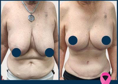 best breast reconstruction with DIEP free flap in Sydney - Dr Vlad ILLIE, specialist plastic and reconstructive surgeon, St Vincent's Hospital Sydney