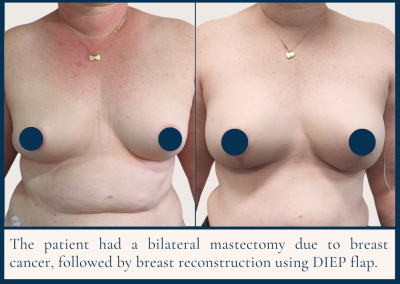 best breast reconstruction with DIEP free flap in Sydney - Dr Vlad ILLIE, specialist plastic and reconstructive surgeon, St Vincent's Hospital Sydney