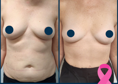 best breast reconstruction with DIEP free flap in Sydney - Dr Vlad ILLIE, specialist plastic and reconstructive surgeon, St Vincent's Hospital Sydney