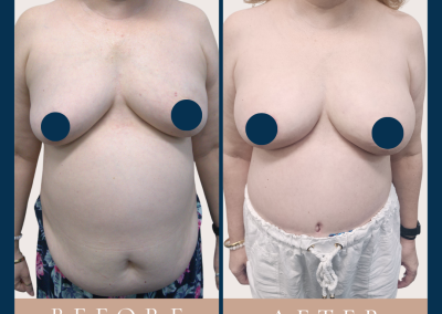 best breast reconstruction with DIEP free flap in Sydney - Dr Vlad ILLIE, specialist plastic and reconstructive surgeon, St Vincent's Hospital Sydney