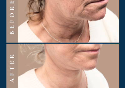 lower facelift in Sydney Eastern Suburbs - Dr Vlad ILLIE