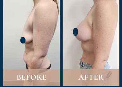 breast lift and implants in Sydney - Dr Vlad ILLIE specialist plastic and reconstructive surgeon