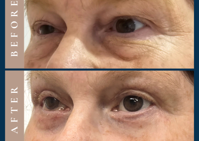 best upper and lower eyelid surgery in sydney blepharoplasty