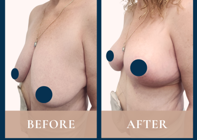 best breast reduction surgeon in Sydney - Dr Vlad ILLIE, specialist plastic and reconstructive surgeon