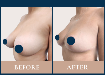 best breast reduction surgeon in Sydney - Dr Vlad ILLIE, specialist plastic and reconstructive surgeon