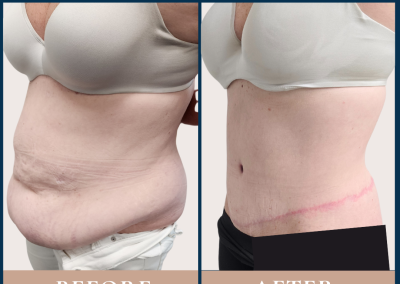 best abdominoplasty and liposuction in Sydney - body contouring surgery in Sydney- Dr Vlad ILLIE, specialist plastic and reconstructive surgeon