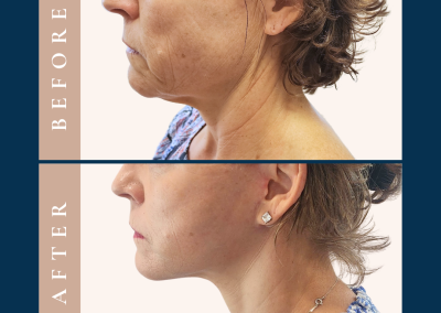 impressive results for deep plane face and neck lift in Sydney Eastern Suburbs - Dr Vlad ILLIE