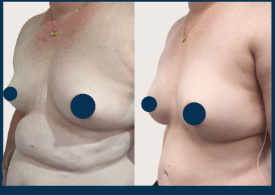 best breast reconstruction with DIEP free flap in Sydney - Dr Vlad ILLIE, specialist plastic and reconstructive surgeon, St Vincent's Hospital Sydney