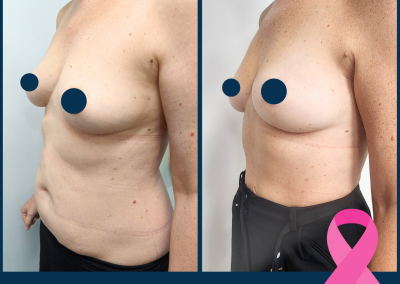 best breast reconstruction with DIEP free flap in Sydney - Dr Vlad ILLIE, specialist plastic and reconstructive surgeon, St Vincent's Hospital Sydney