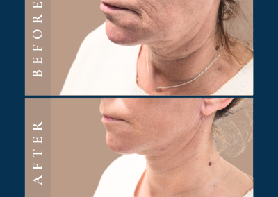 lower facelift in Sydney - Dr Vlad ILLIE