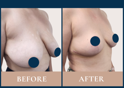 breast reduction in Sydney - Dr Vlad ILLIE specialist plastic and reconstructive surgeon