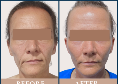 best surgeon deep plane facelift in Sydney Eastern Suburbs - Dr Vlad ILLIE