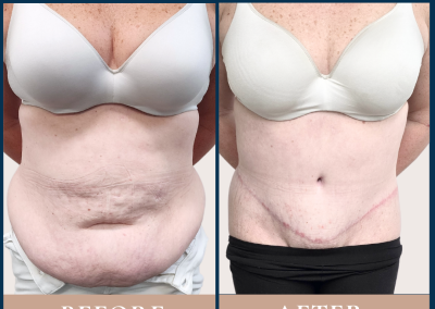 best radical abdominoplasty and liposuction in Sydney- Dr Vlad ILLIE, specialist plastic and reconstructive surgeon