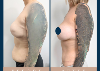 best breast reconstruction with DIEP free flap in Sydney - Dr Vlad ILLIE, specialist plastic and reconstructive surgeon, St Vincent's Hospital Sydney