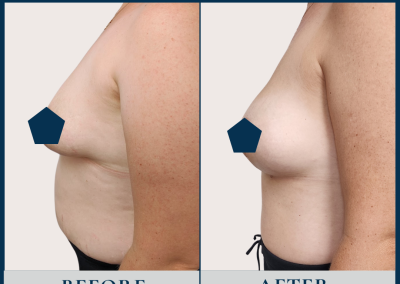 best breast reconstruction with DIEP free flap in Sydney - Dr Vlad ILLIE, specialist plastic and reconstructive surgeon, St Vincent's Hospital Sydney