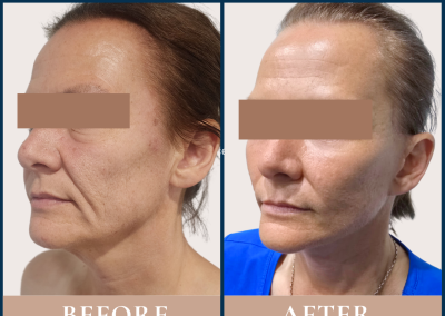 best surgeon for deep plane facelift in Sydney - Dr Vlad ILLIE