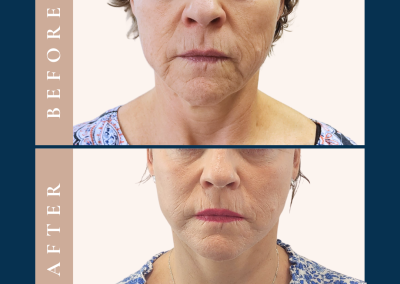 amazing deep plane face and neck lift in Sydney - Dr Vlad ILLIE