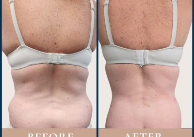 best back contouring surgery in Sydney with liposuction - Dr Vlad ILLIE, specialist plastic and reconstructive surgeon