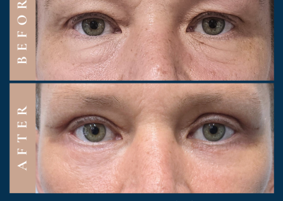 best surgeon for upper and lower blepharoplasty eyelid surgery in Sydney - Dr Vlad ILLIE