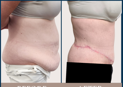 abdominoplasty and liposuction in Sydney- Dr Vlad ILLIE, specialist plastic and reconstructive surgeon