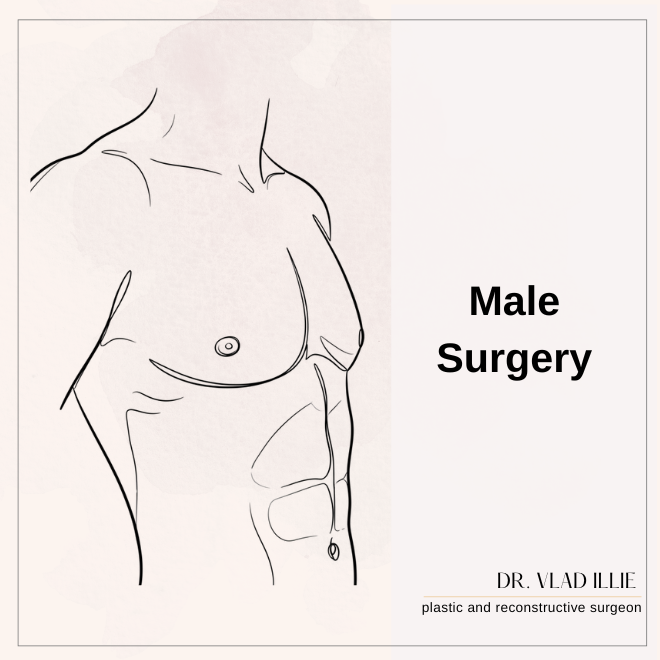 Gynecomastia Sydney male breast reduction